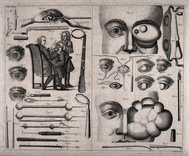 Nákresy rôznych nástrojov používaných pri operáciách oka a príklad zákroku z 18. storočia