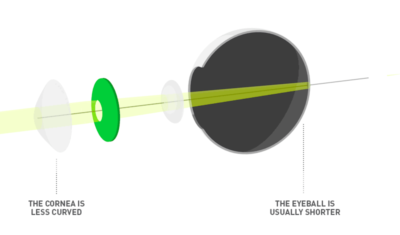 Long-sightedness
