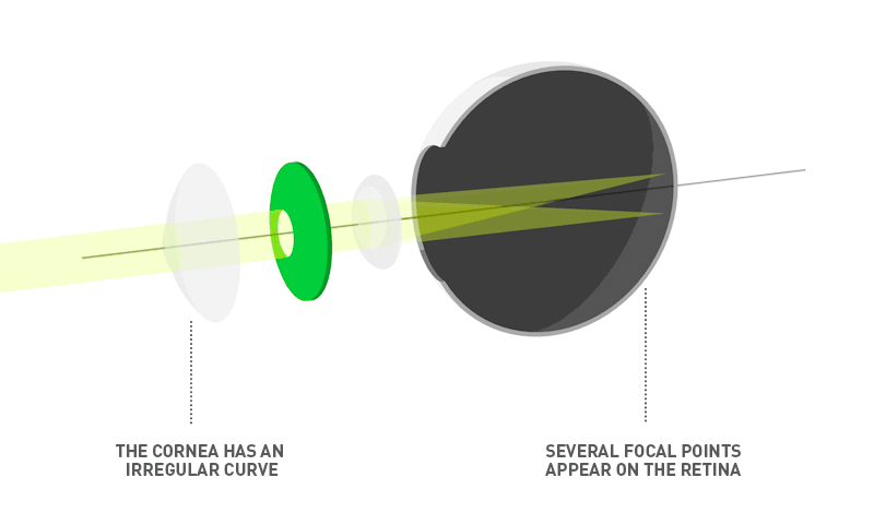Astigmatism