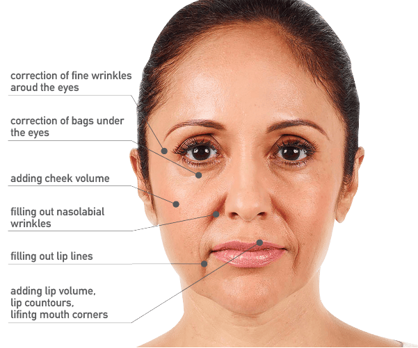 IMPLANT FILLERS