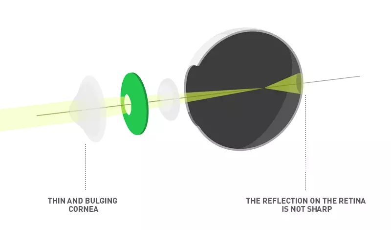 Keratoconus