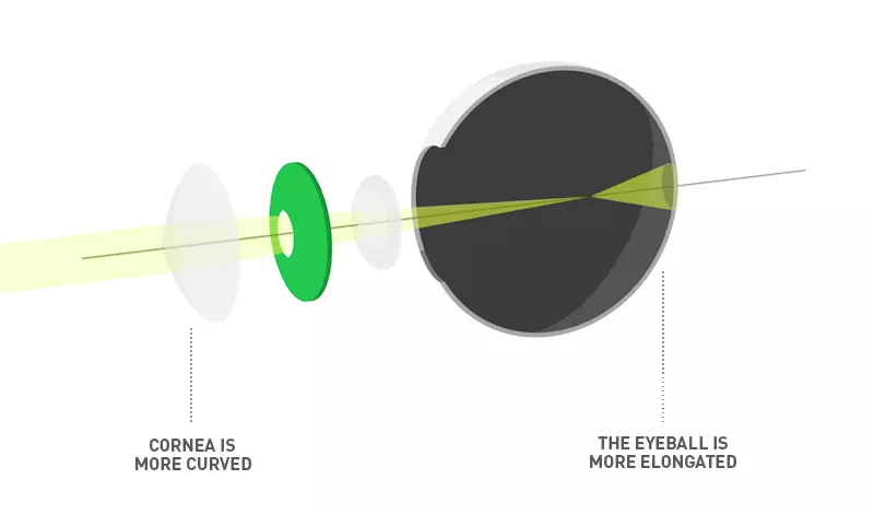 Short-sightedness