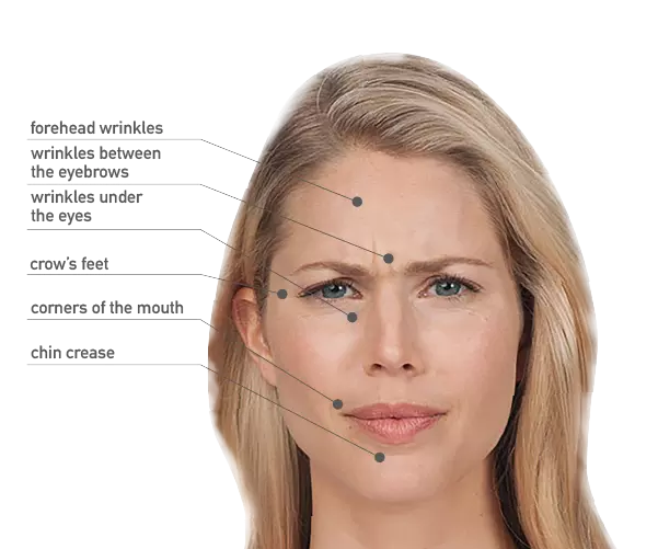Wrinkle reduction