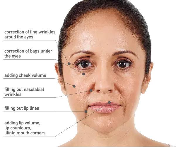 IMPLANT FILLERS