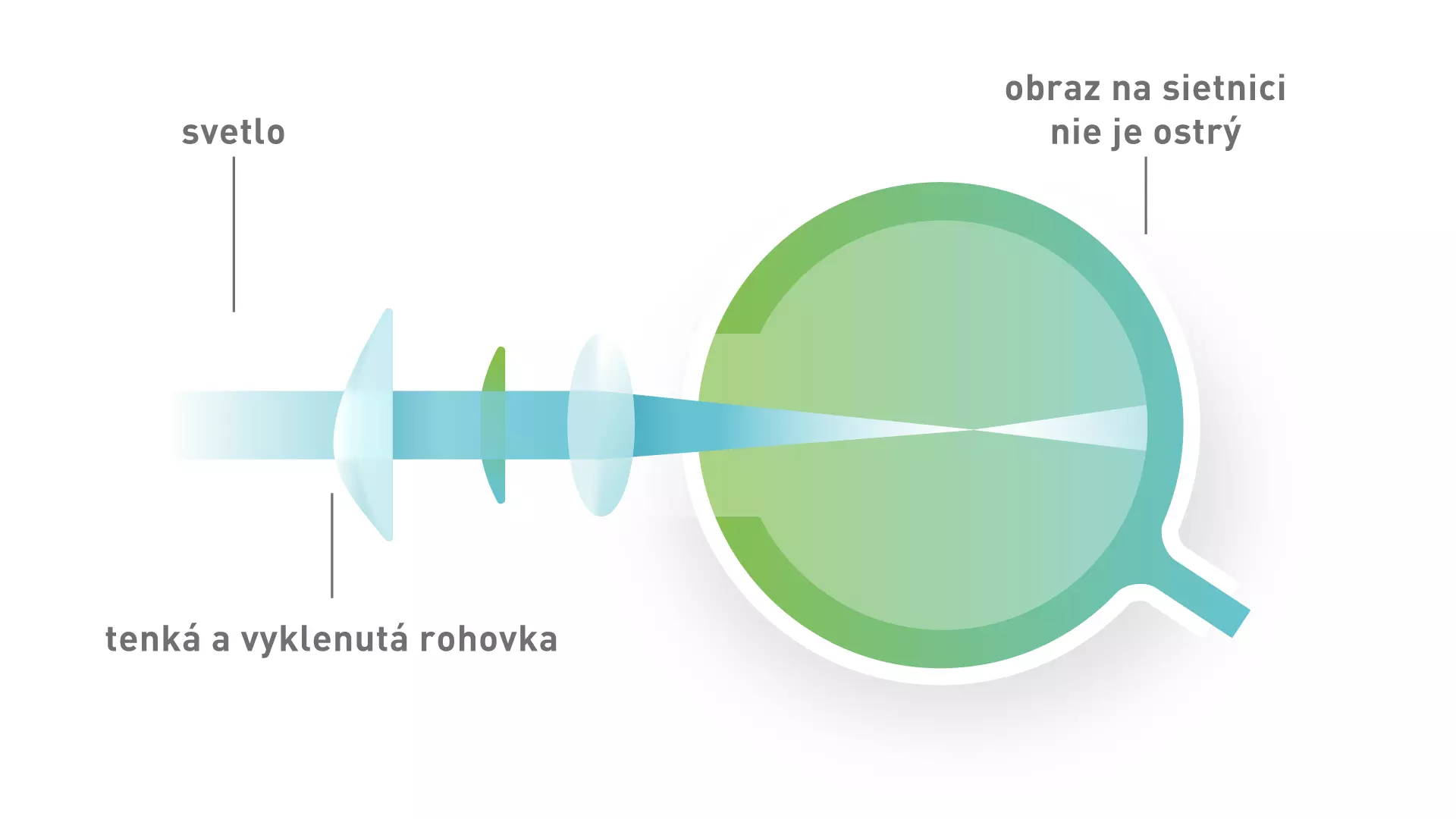 Keratokónus
