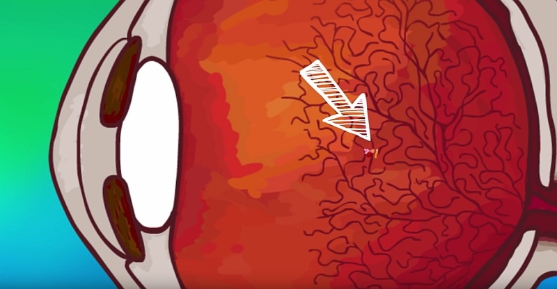 Animovaný film: Ako vznikajú zákaly sklovca?