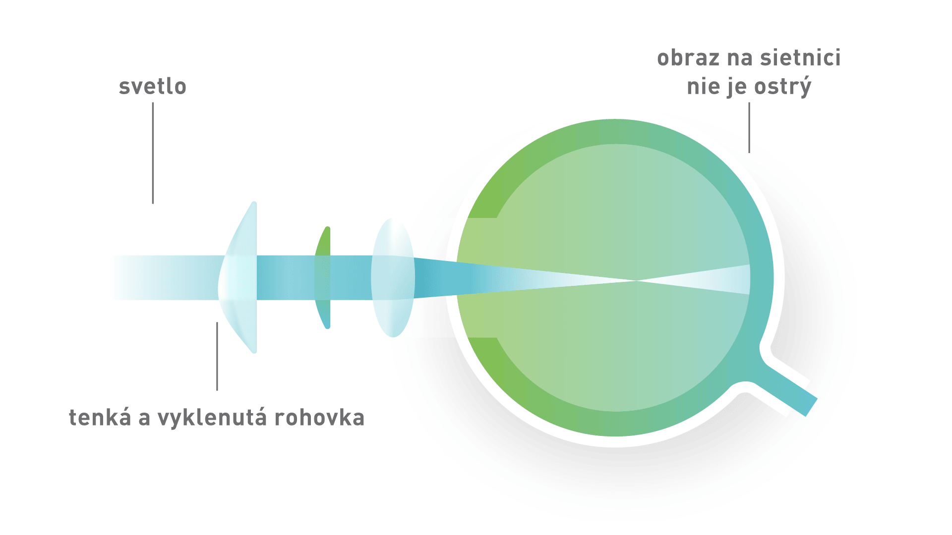 Keratokónus