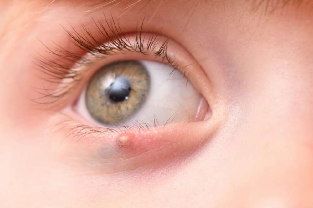 Jačmeň na oku je bežné, no bolestivé ochorenie. Prečo vzniká a ako ho liečiť?