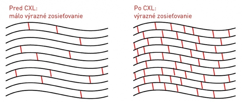 Zákrok je bezpečný a rýchly, pacienti sa navyše vyhnú aj komplikovanej transplantácii rohovky.